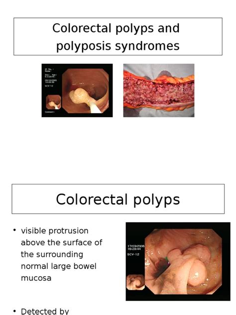 Polyps and Polyposis | Adenoma | Colorectal Cancer