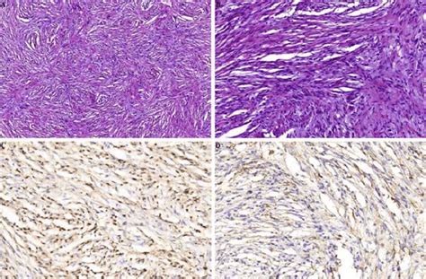 Hybrid Neurofibroma Perineurioma A B Different Arrangement Of The