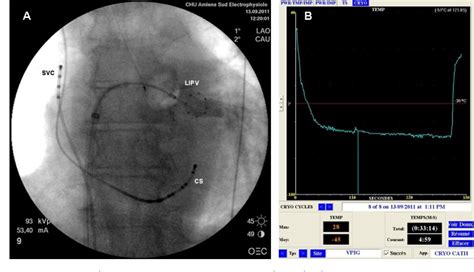 Figure 1 From Visualization Of Effects Of Cryoballoon Ablation During Percutaneous Treatment Of