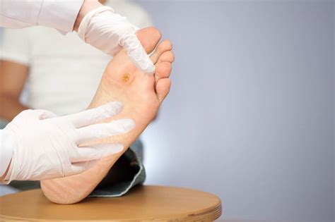 Skin Conditions Foot Treatment In Launceston Cornwall Podiatrist