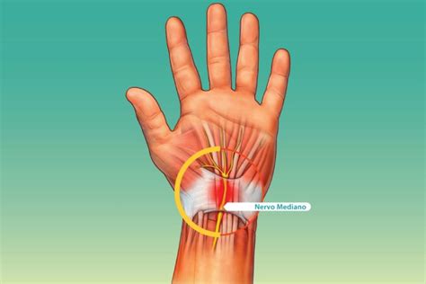 Tunnel Carpale Disturbo Neurologico Per Il Nervo Mediano XXI Secolo