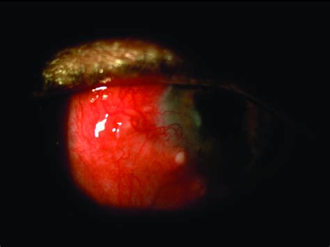 Scleritis Affecting The Peripheral Adjacent Cornea Is Highly Suggestive