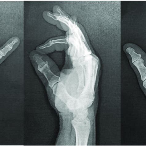 Radiographs X Rays Of The Right Hand With Evidence Of The Middle Download Scientific Diagram