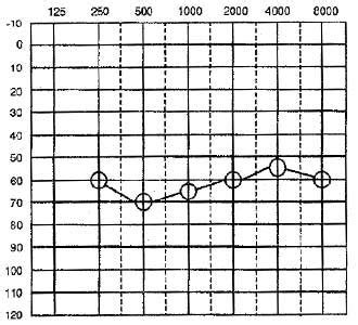 Pure Tone Audiogram: Symbols | Types | Interpretation