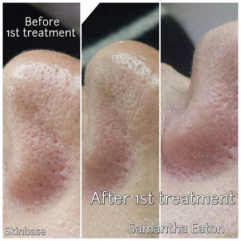 Microdermabrasion Before And After Skinbase Microdermabrasion