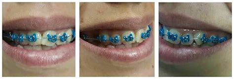 10 colored blue braces for adults and kids | Braces Explained