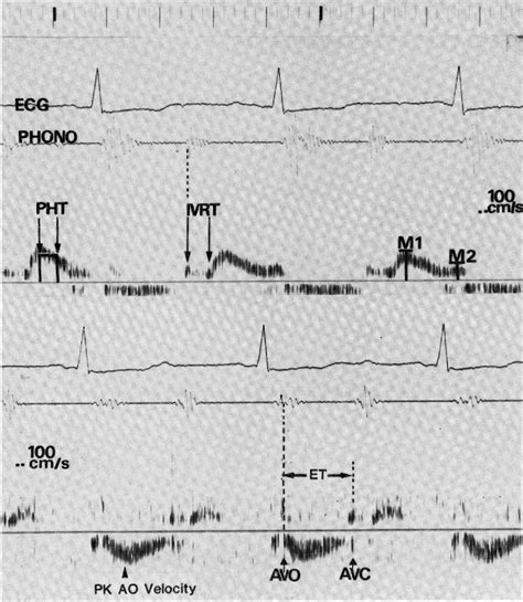 Figure From A Hemodynamic And Doppler Echocardiographic Study Of