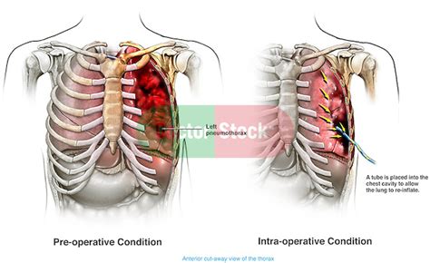 Pneumothorax With Placement Of A Chest Tube To Re Inflate The Lung