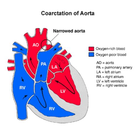 NURS 4010 Week 2 Pediatric Perfusion Flashcards Quizlet