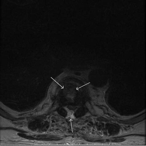 Transverse View Of Thoracic Spine Magnetic Resonance Imaging Mri Mri Download Scientific