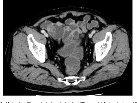 Figure From A Case Of Single Incision Laparoscopic Surgery For A