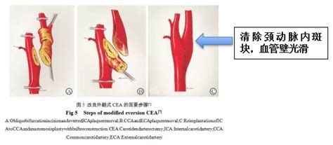 翻转式颈动脉内膜剥脱术示意图