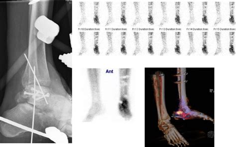 Nuclear Medicine Imaging Of Posttraumatic Osteomyelitis Springerlink