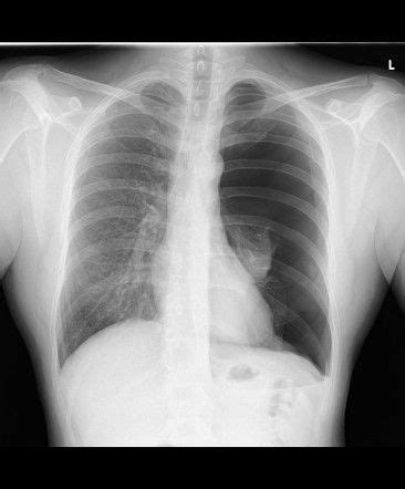 X Ray Findings Of Pneumothorax MEDizzy