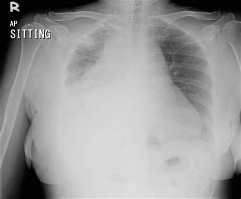 Widened Mediastinum Radiology Cases