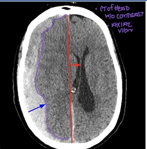 Traumatic Brain Injury Flashcards Quizlet