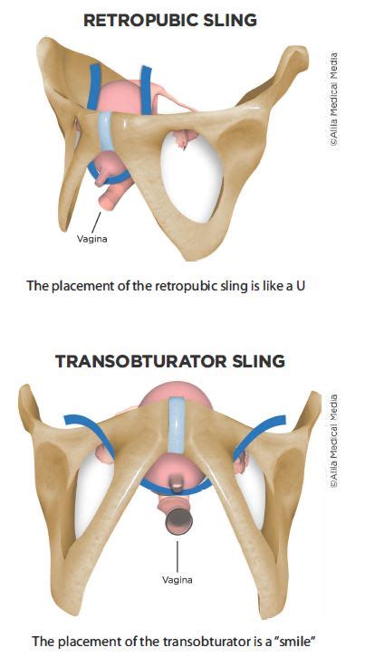 Mid Urethral Sling Comprehensive Services For Women At Chi St Vincent