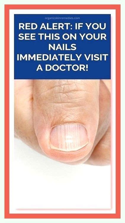 Red Alert If You See This On Your Nails Immediately Visit A Doctor