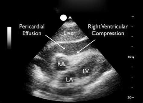 Pericardial Effusion Ultrasound