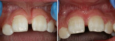 Labial Frenectomy Before And After