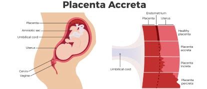 Placenta Accreta: Types, Risks, Causes Treatment, 56% OFF