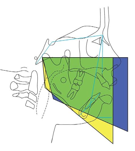 Figure2C Superimposition Tetrahedron Angle 50º in Yellow and 70º