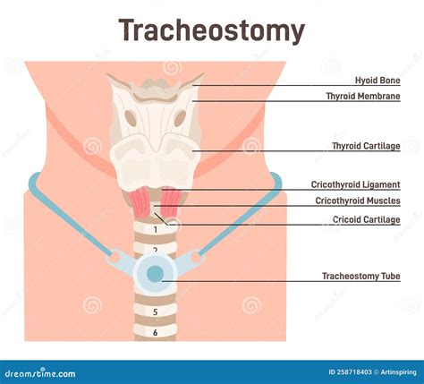 Tracheostomy Tracheal Surgery Neutralise Airway Obstruction Plastic