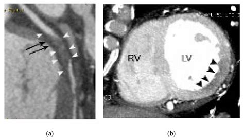 Fat Stranding In A 75 Year Old Male Patient With Acute Myocardial