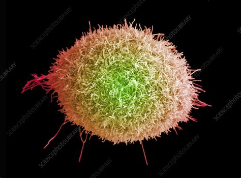 Cervical Cancer Cell SEM Stock Image C059 3626 Science Photo Library