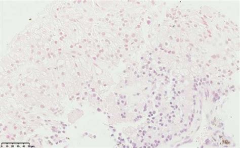 Hematoxylin And Eosin Staining Demonstrates Clear Cells With Abundant