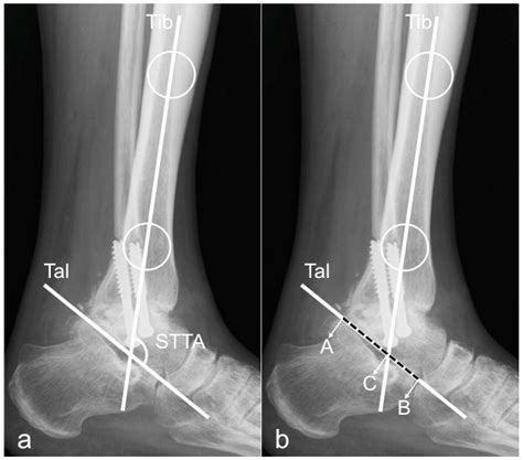 Normal Lateral Ankle Xray