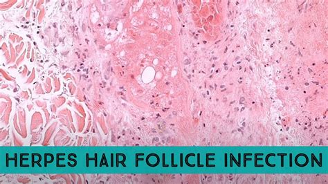 Herpes Hair Follicle Infection (Herpetic Folliculitis) with follicle ...