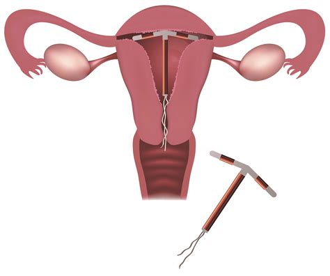 Hormone Releasing Intrauterine Devices Iuds