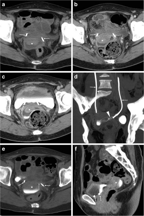 Multidetector CT Of Expected Findings And Complications After