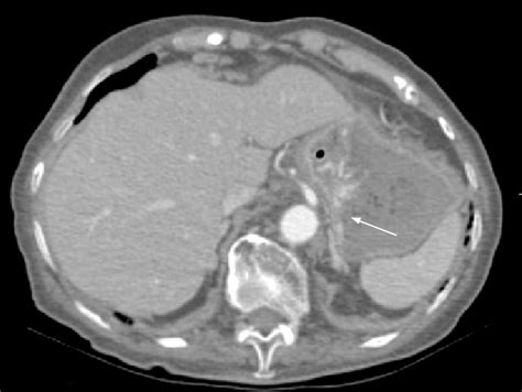 Contrast Enhanced Emergent Ct Showing Lesions Arrow In The Stomach