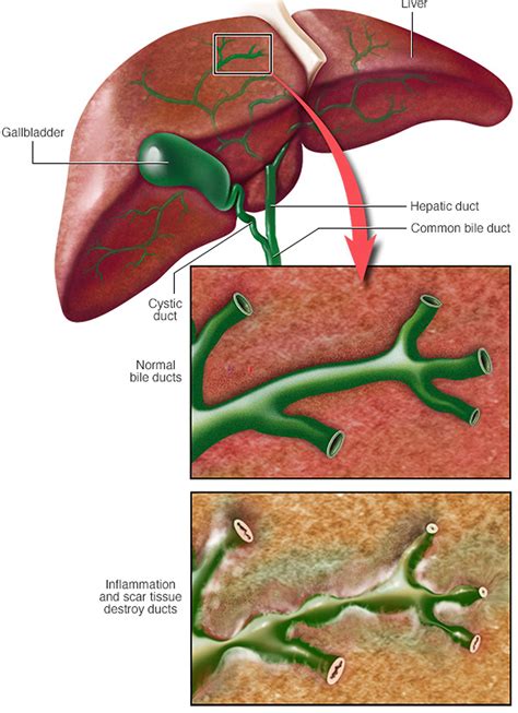 Primary Sclerosing Cholangitis Causes Symptoms Prognosis Treatment