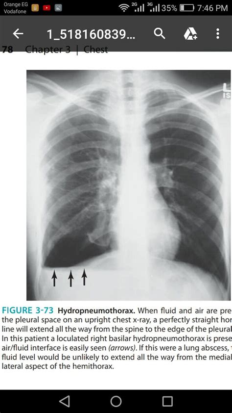 Hydropneumothorax Radiology Imaging Pediatric Medicine Radiology