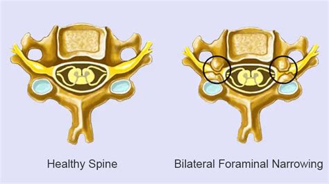 What Is Neural Foraminal Narrowing