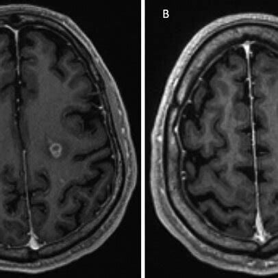 Axial T Weighted Postcontrast Brain Mri Demonstrating Two Of Nine