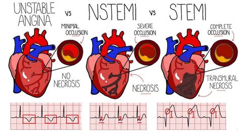 Non St Elevation Myocardial Infarction Diagnosis And 46 Off