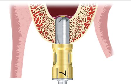 Sinus Lift Krestal Hybrid Fortbildung Bedent