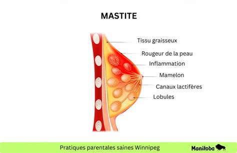 Traitement De La Mastite • Pratiques Parentales Saines Winnipeg