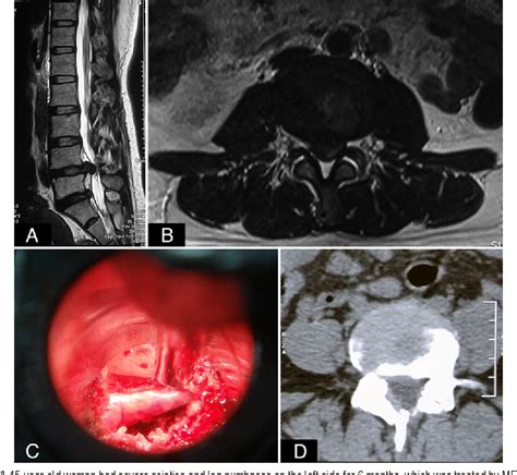 Figure From Comparison Of Percutaneous Endoscopic Transforaminal