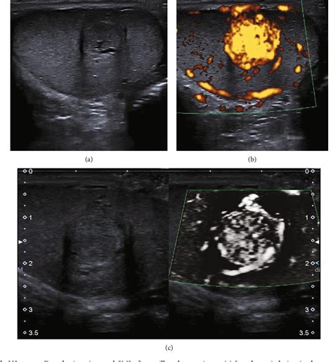 Figure 1 From Multiparametric Ultrasound Mpus Of A Rare Testicular