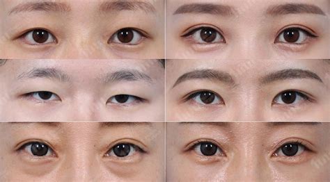 Korean Plastic Surgery Eyelid