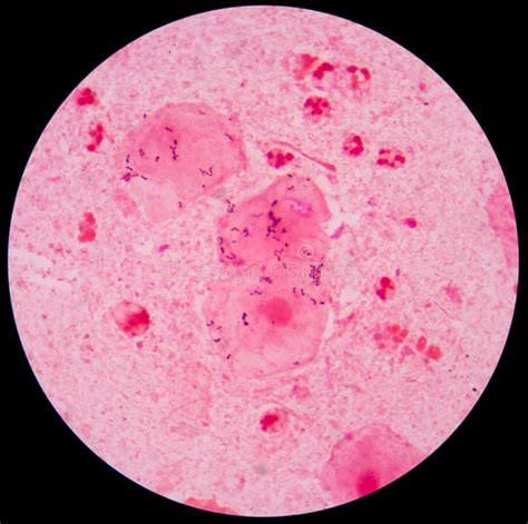 Red Leukocyte In Sputum Gram Stain Stock Photo - Image: 63192913