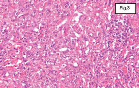 Figure 3 From Primary Splenic Angiosarcoma Revealed By Bone Marrow