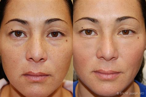 Botox Before And After Frown Lines