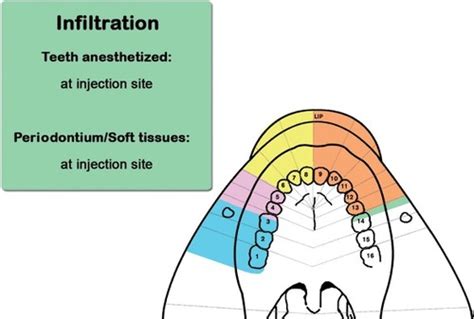 Local Anesthesia Ch 12 Injections For Maxillary Pain Control I