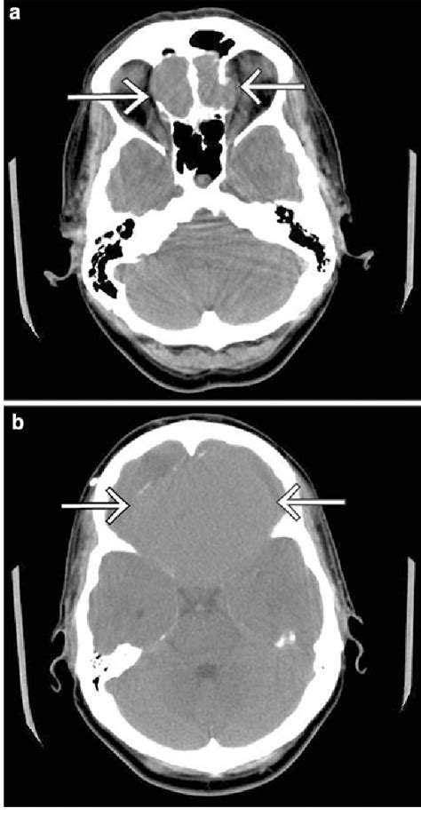 figure    unusual   subfrontal meningioma  case